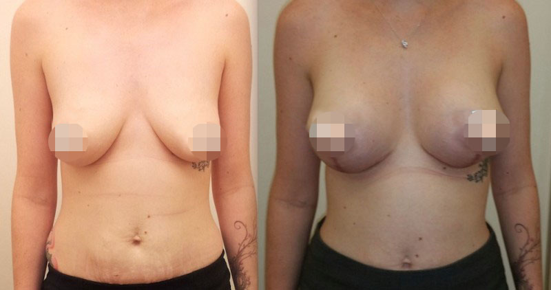 Breast Lift CosMediTour