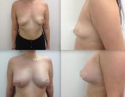 Breast Augmentation CosMedITour