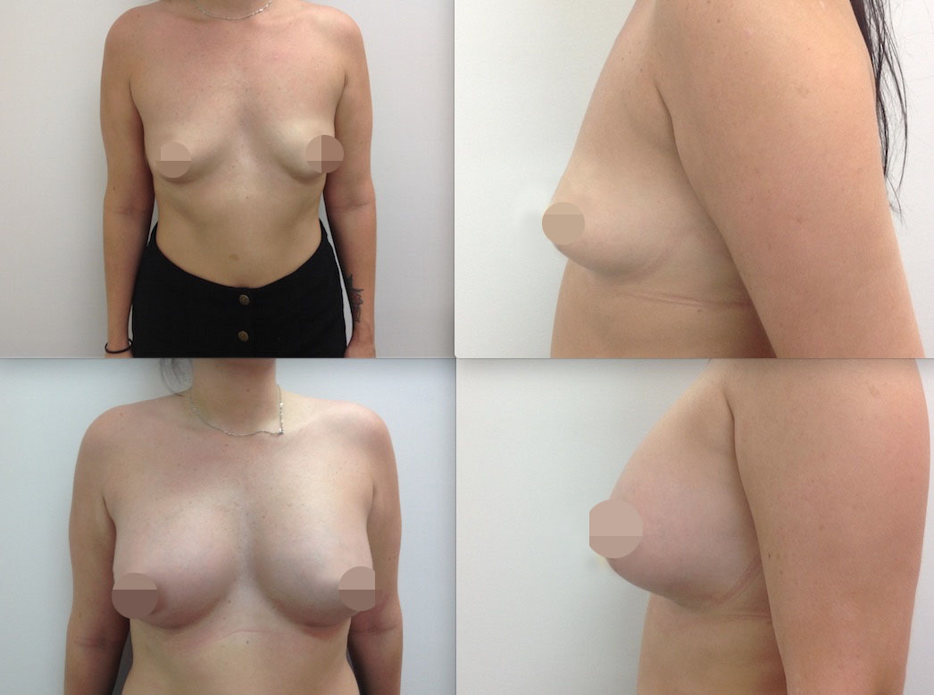 Breast Augmentation CosMedITour