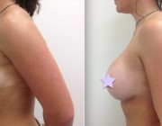 Breast Augmentation - 375cc, High Profile, Round Implants, Over the Muscle, Under the Breast Fold.