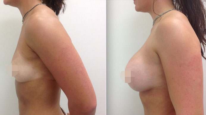 Breast Augmentation CosMediTour