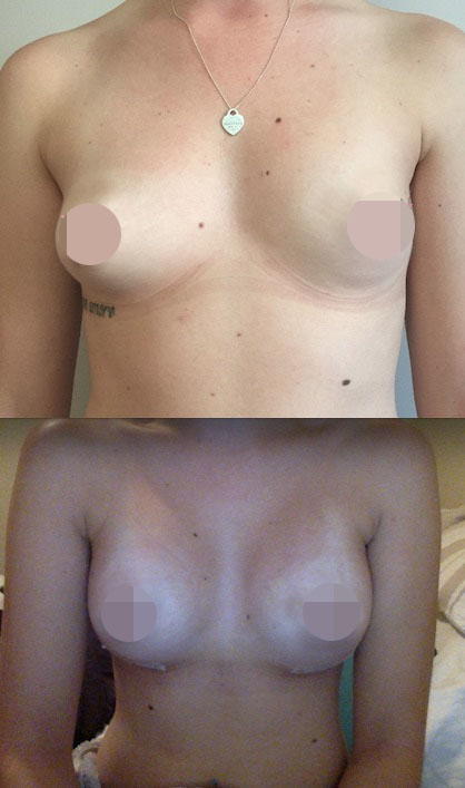 Breast Augmentation CosMediTour