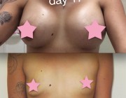 Breast Augmentation - 500cc, High Profile, Round Implants, Under the Muscle, Under the Breast Fold
