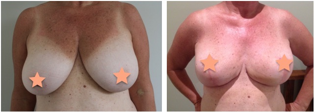 Breast Reduction Before & After #7