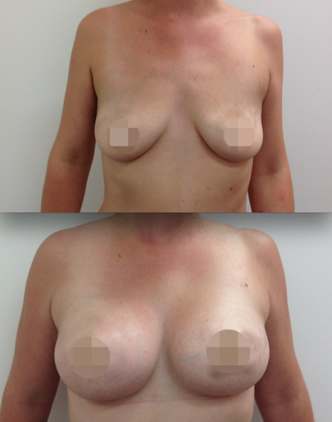 Breast Augmentation CosMediTour