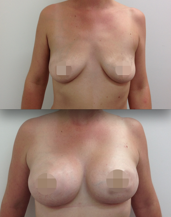 Breast Augmentation + Nipple Lift Results!