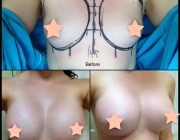 Breast Augmentation - 385cc, Moderate Profile, Round Implants, Over the Muscle, Under the Breast Fold