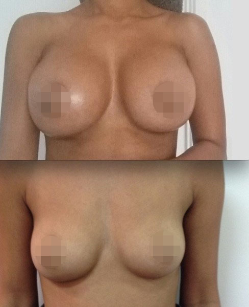 Breast Augmentation CosMediTour