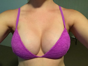 breast-augmentation 2