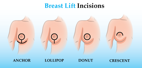 breast-lift