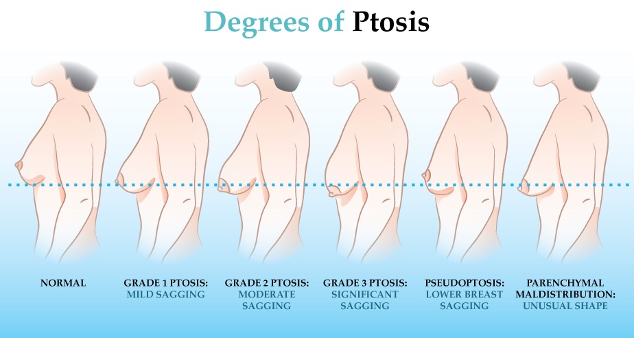 breast-ptosis (2)