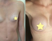 Breast Augmentation - 350cc, High Profile, Round Implants, Under the Muscle, Under the Breast Fold