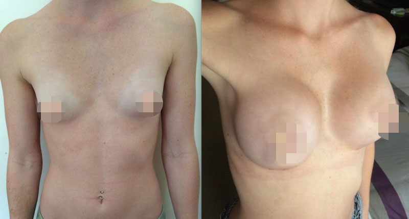 Breast Augmentation CosMediTour