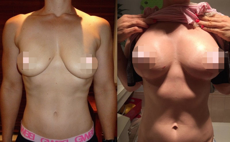 Breast Lift CosMediTour