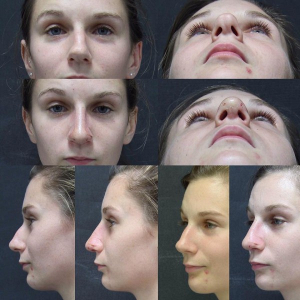 Nose correction