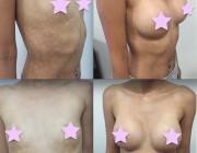 Breast Augmentation - 375cc, Round, High Profile, Under the Muscle Placement.