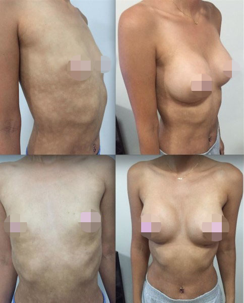 Breast Augmentation CosMediTour