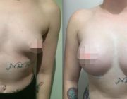 Breast Augmentation CosMediTour