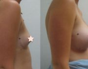 Breast Augmentation