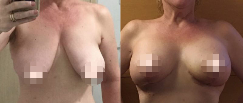 Breast Lift CosMediTour