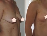 Breast Lift + Augmentation - 275cc, High Profile, Round Implants, Under the Muscle