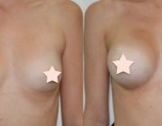 Breast Augmentation - 250cc, Round Implants