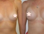 Breast Augmentation - 275cc, Round Implants