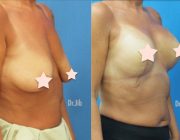 Breast Augmentation + Lift - 8 Days Post op 350cc, Round Implants