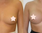 Breast Augmentation - 375cc