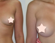 Breast Augmentation - 400cc
