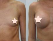 Breast Augmentation