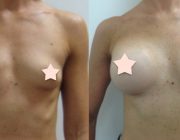 Breast Augmentation - L 275cc / R 300 cc, Round Implants
