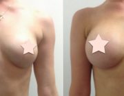 Breast Augmentation - 350cc, Round Implants, Under the Muscle