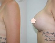 Breast Augmentation