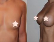 Breast Augmentation - Round Implants, Under the Muscle