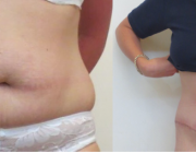 Tummy Tuck