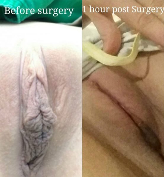 CosMediTour Labiaplasty Transformation 