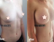 Breast Augmentation - 350cc, Low Profile, Round, Under the Muscle, Under the Breast Fold