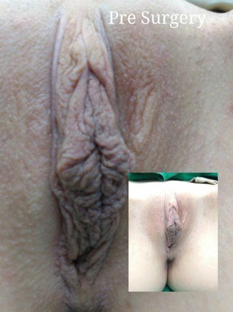 labiaplasty