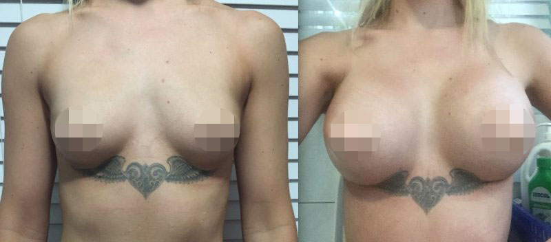 Breast Augmentation CosMediTour