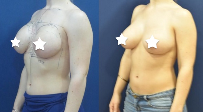 Breast Revision Before and After #6