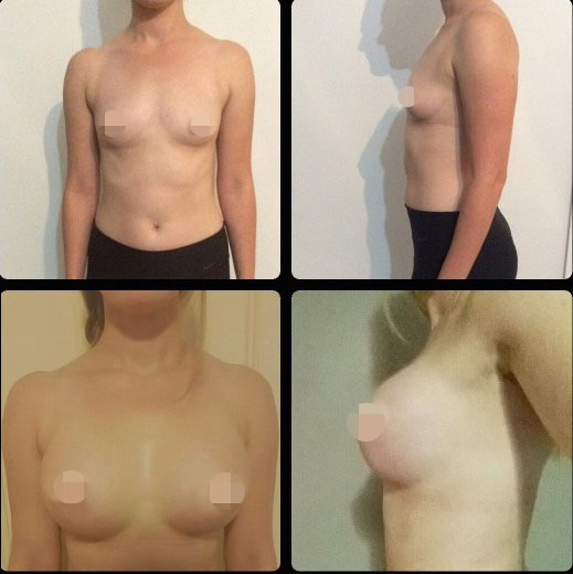 Breast Augmentation CosMediTour