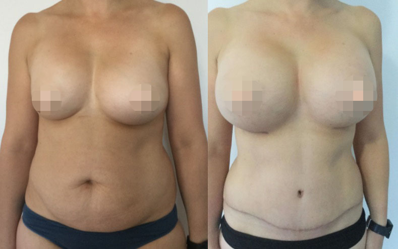 Breast Revision Before and After #7