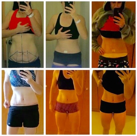 tummy-tuck-progress