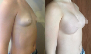 Breast Augmentation CosMediTour