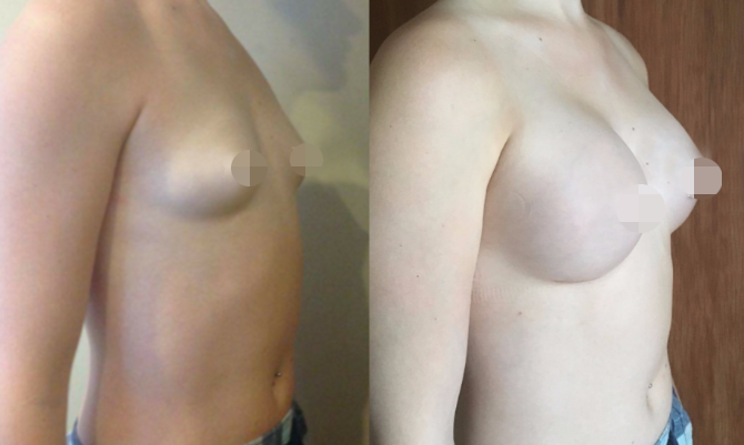 Breast Augmentation CosMediTour