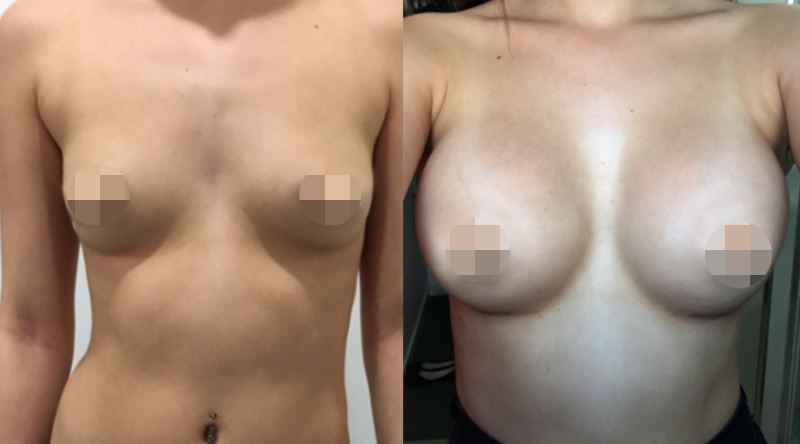 Breast Augmentation CosMediTour