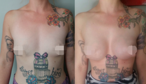 Breast Augmentation CosMediTour