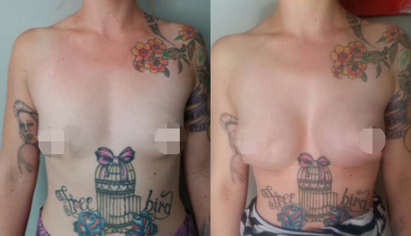 Breast Augmentation Before & After #337