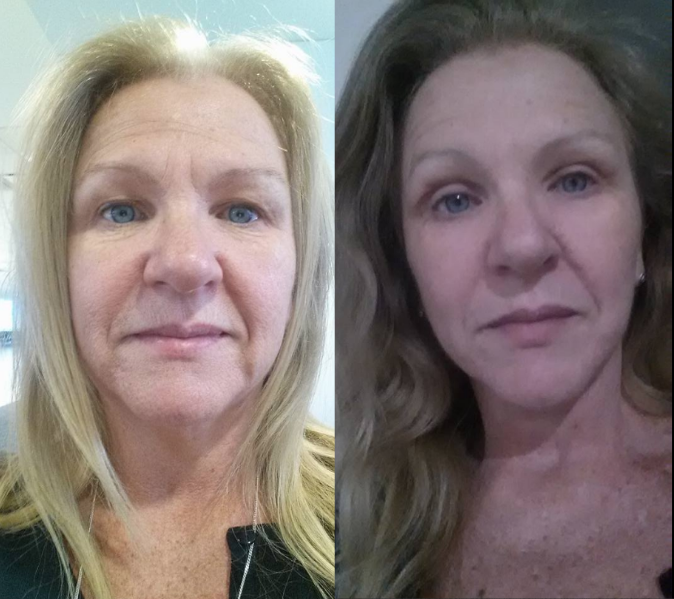 6 weeks post op facelift results